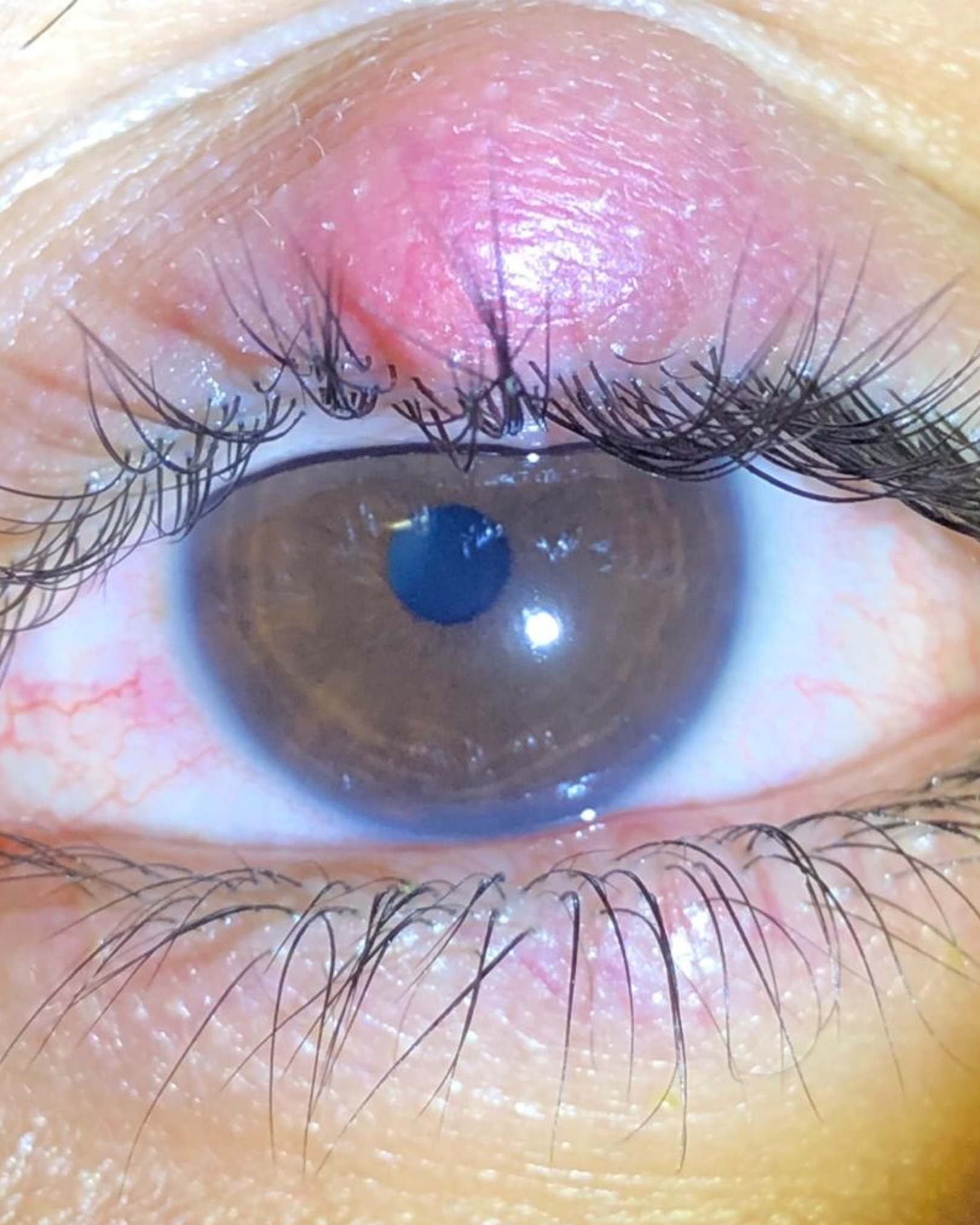 Chalazion